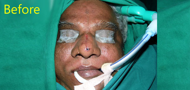 Faciomaxillary surgery